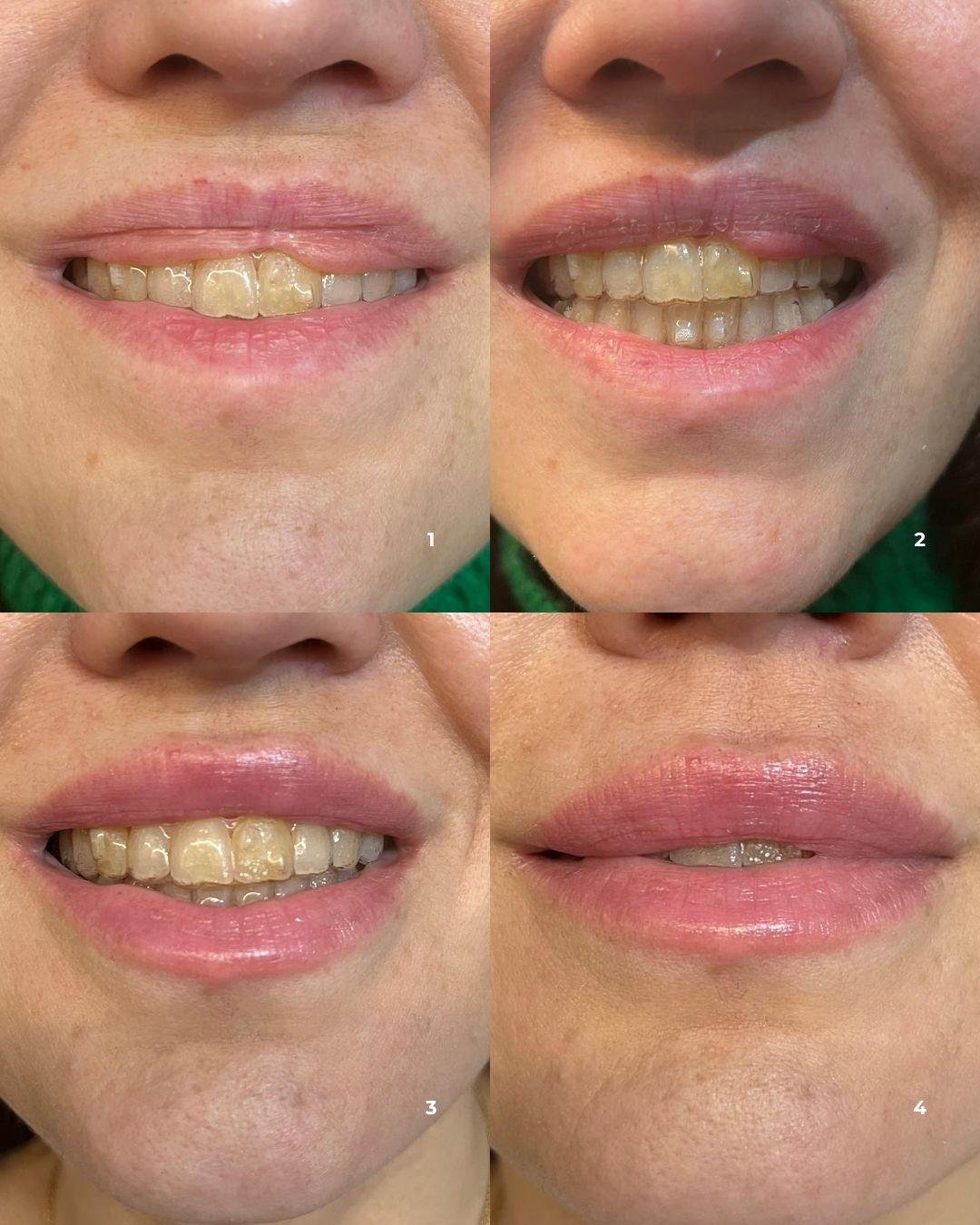 Relleno de Labios en Madrid - Caso de migración de ácido hialurónico