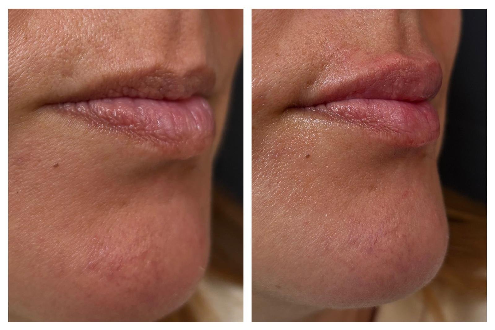 Relleno de Labios en Madrid - Tratamiento realizado por la Dra. Ava Ardila